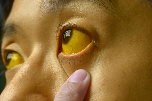 alcoholic jaundice eyes